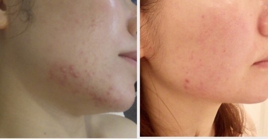 ニキビ治療美容鍼ならプメハナ鍼灸整骨院 葛飾区亀有