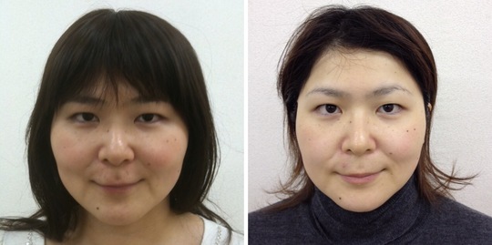 美顔 小顔コースならプメハナ鍼灸整骨院 葛飾区亀有